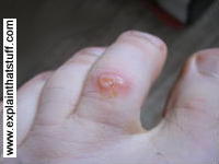 A walker's blister on the toe of a foot